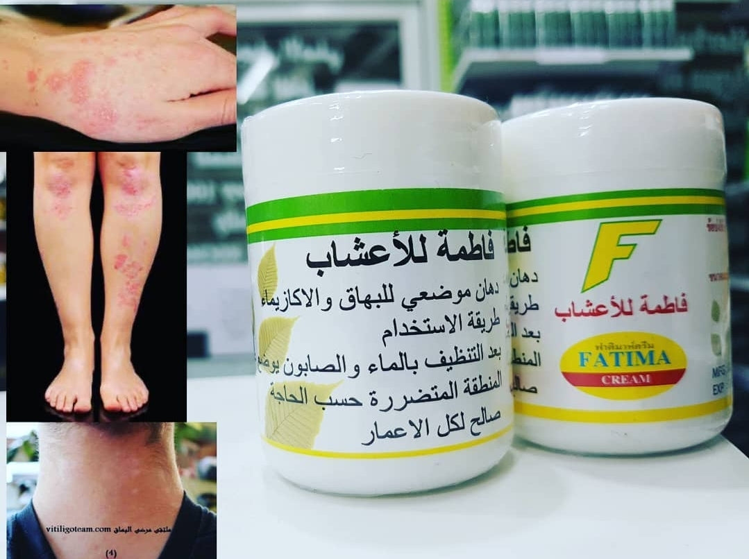 Fatima Cream For Treatment Of Eczema and Vitiligo | كريم فاطمة لعلاج الاكزيما و البهاق