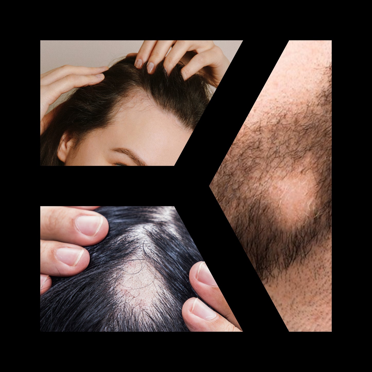 Alopecia Ointment | دهان الثعلبة